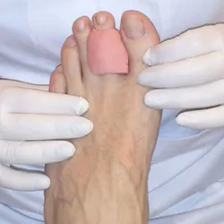 ORTESIS DE SILICONA A MEDIDA