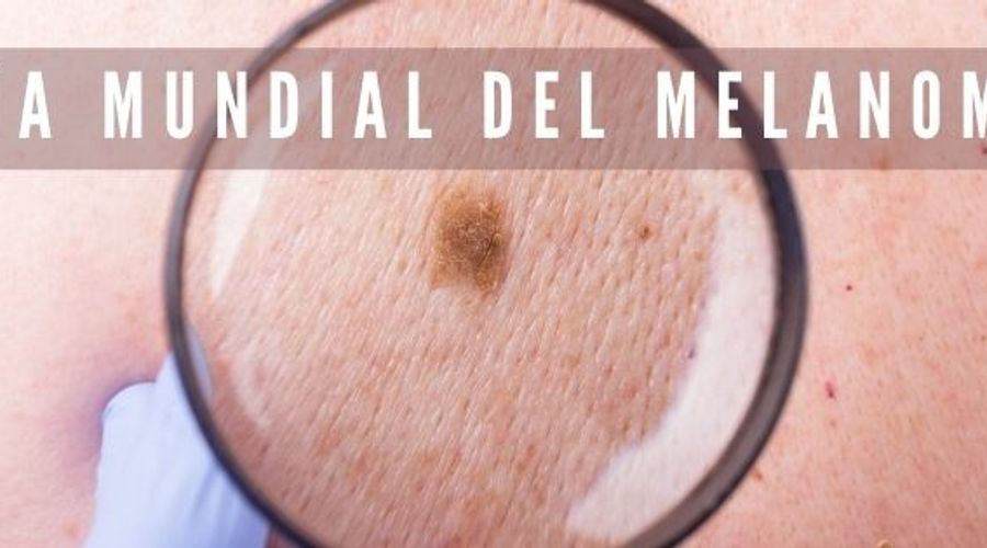 23 DE MAYO… DÍA MUNDIAL DEL MELANOMA