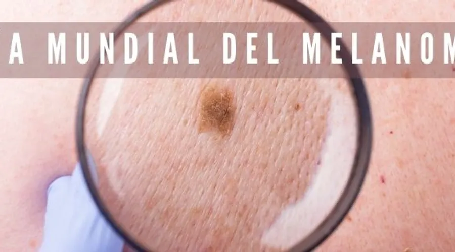 23 DE MAYO… DÍA MUNDIAL DEL MELANOMA