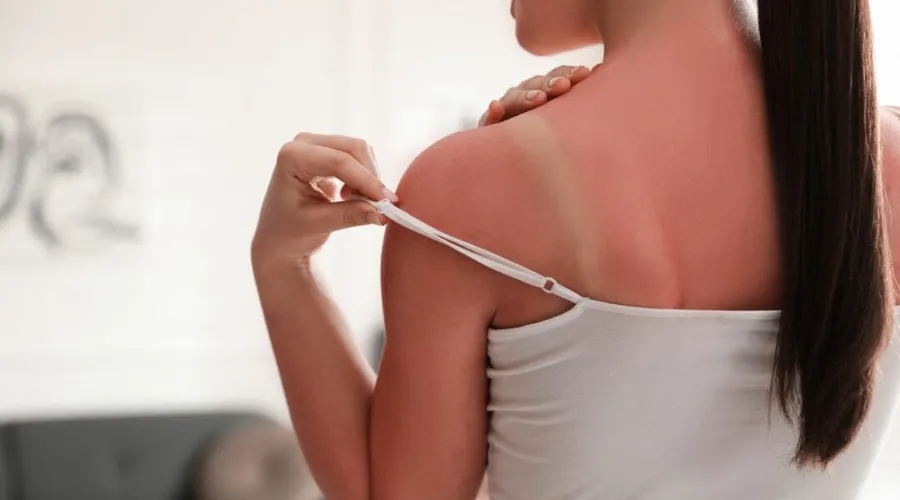 ¿Qué hacer ante una quemadura solar?