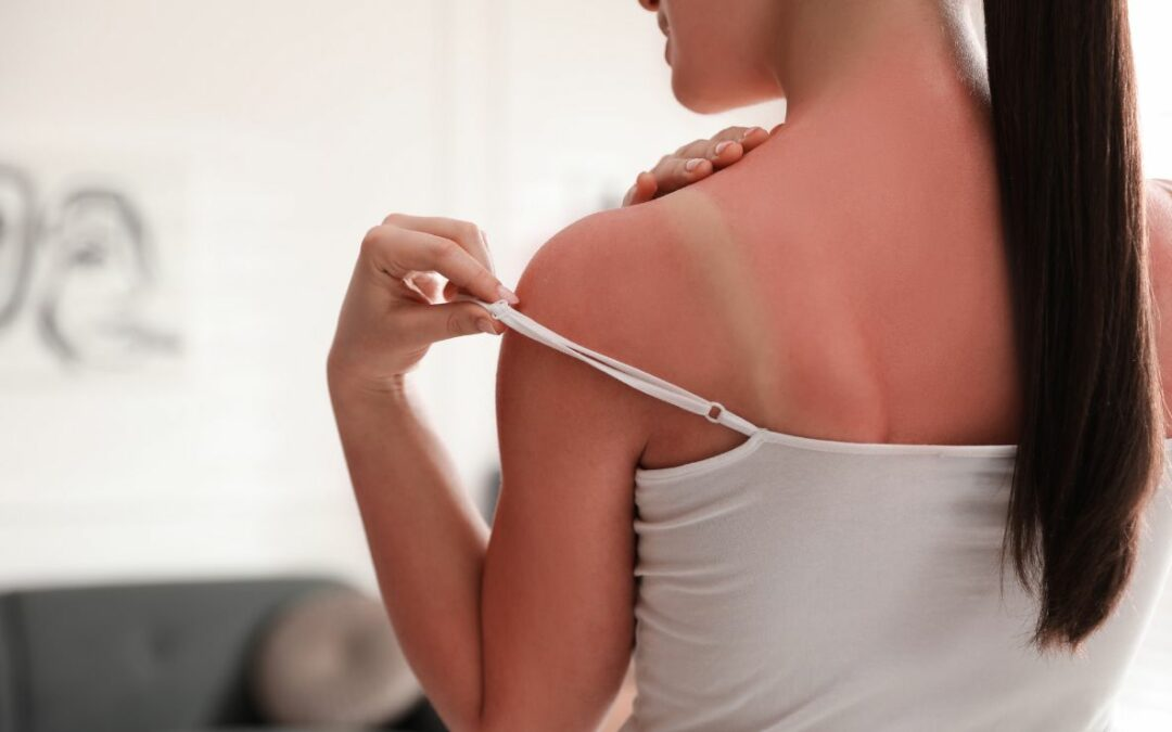 ¿Qué hacer ante una quemadura solar?