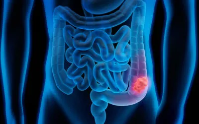 Día Mundial del Cáncer Colorrectal